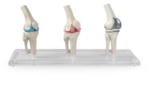 anatomisches Modell, Knie Implantat, 3 Modelle, 3 Stadien, beweglich, mit Stativ