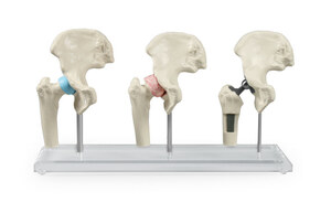anatomisches Modell Hfte 3 Stadien: gesund, erkrankt, mit Implantat, mit Stativ