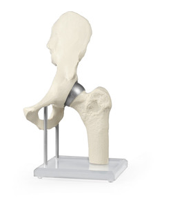 H�ftmodell mit Schalenprothese