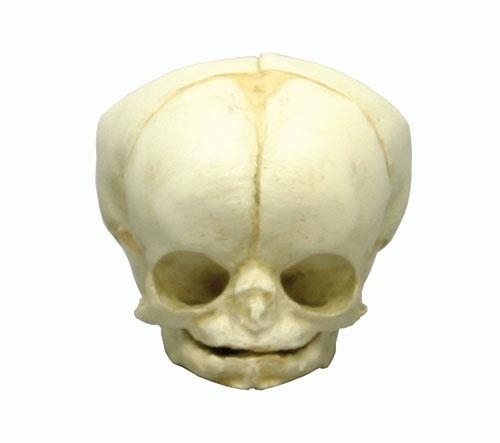 Fetussch�del, 35 Wochen