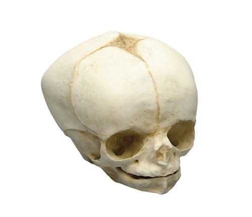 Fetussch�del, 34 Wochen