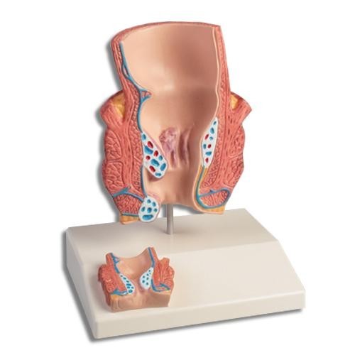 H�morrhoidenmodell, H�morrhoiden Modell Urologie