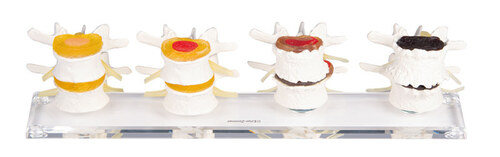 Stadien der Bandscheibensch�digung, 4 Lendenwirbel-Paare, 3 Pathologien