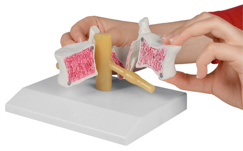 Osteoporose Wirbel 2-fach vergr��ert, mit Stativ